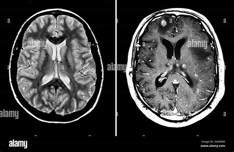 Brain Fibers Mri Black And White Stock Photos And Images Alamy