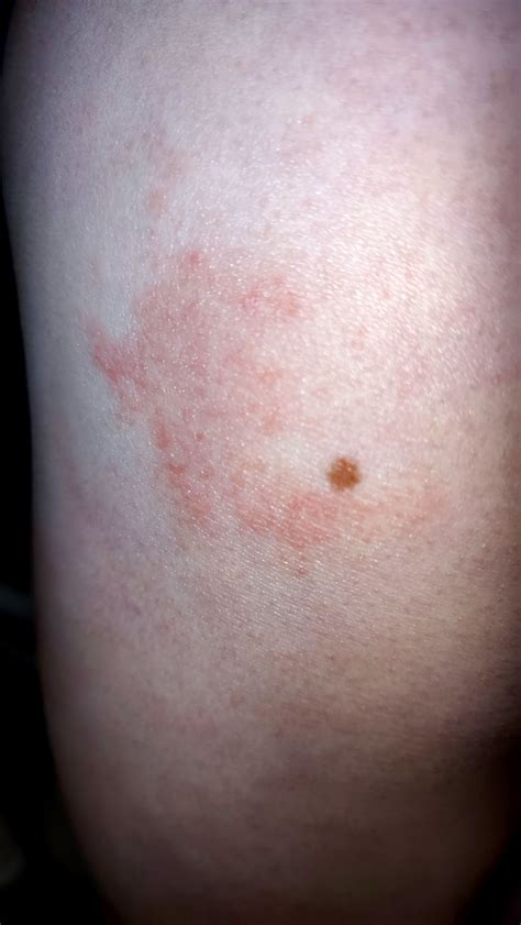 Recurring Rash Raskdocs