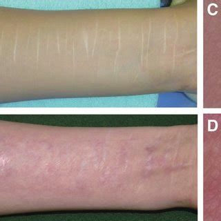 Pdf Treatment Of Deliberate Self Harm Scars With Rotated Thin Skin