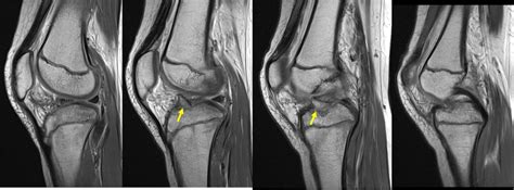 Avulsion Fracture Of ACL Radiology Cases