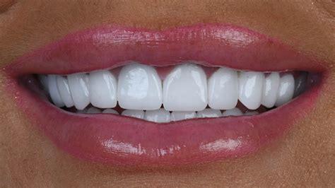 Zirconium Crowns Hsmile Dental Clinic Turkey Dental