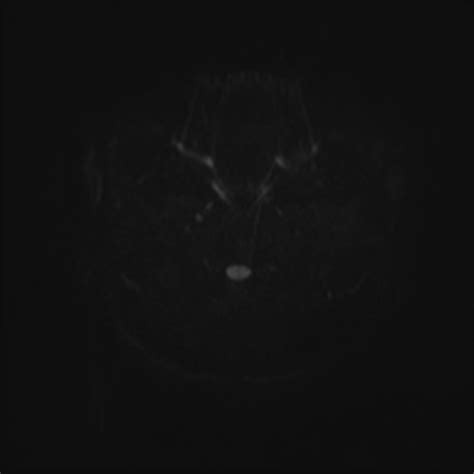 Septo Optic Dysplasia Image Radiopaedia Org