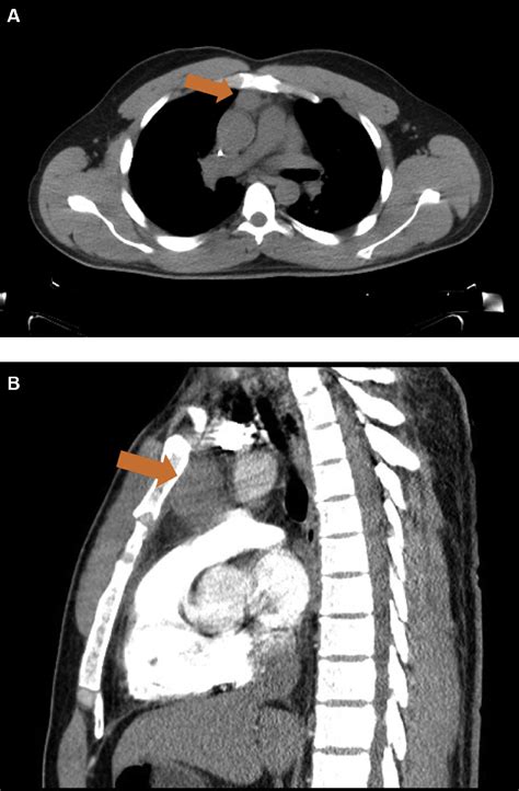 Thoracoscopic Resection Of A Nonseminomatous Primary Mediastinal Germ