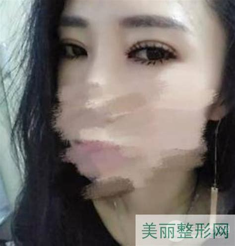 郑州二附院整形科咋样？医生名单丨杨丽眼修复术后果反馈~美嘉整形网美学知识