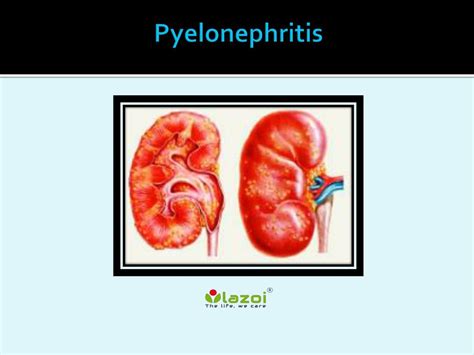 Ppt Pyelonephritis Causes Symptoms Daignosis Prevention And Treatment Powerpoint