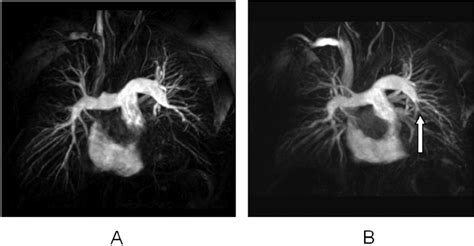 Maximum Intensity Projection Image Of A Magnetic Resonance Pulmonary