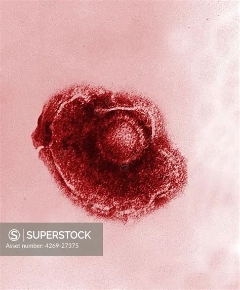 Varicella Zoster Virus Color Enhanced Electron Micrograph Of Varicella Chickenpox Virus The