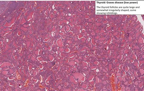 Thyroid Graves Disease Nus Pathweb Nus Pathweb