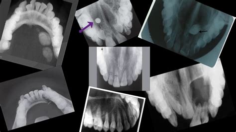 The Purpose Of The Occlusal Technique Occlusal Radiographs Youtube