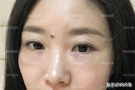 超微创去眼袋术后效果如何？40也能找回美丽明眸！ 知乎