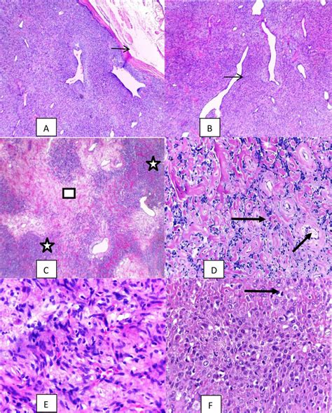 Histopathology Of Sft A Well Circumscribed Tumor → 40x B Cellular