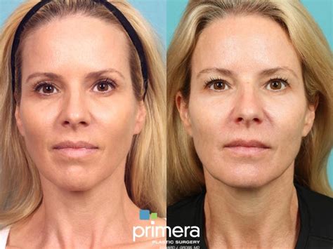 Sculptra® Before And After Pictures Case 906 Orlando Florida