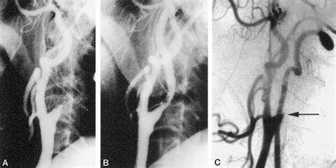 Case 1 Right Carotid Angiograms Lateral View Show Occlusion At The Download Scientific