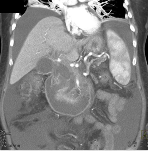 Pancreatic Cancer Invades And Obstructs The Duodenum Pancreas Case