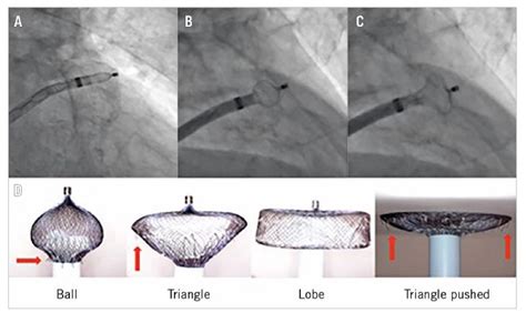 Figure Evolutionary Steps In Safer Deployment Of The Amplatzer