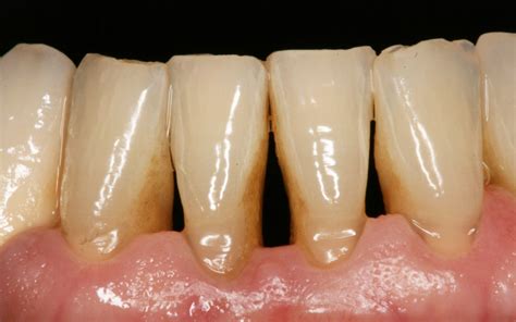 ABC de la Odontología Durante el Embarazo Dentilandia