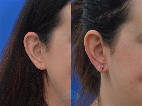 Earlobe Repair Before And After Pictures Case Charlotte Nc