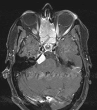 patient   multiple meningiomas  endonasal  subfrontal