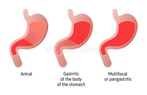 Gastritis An Inflammation Irritation Or Erosion Of The Lining Of The