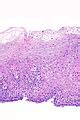 Glycogenic acanthosis of the esophagus - Libre Pathology