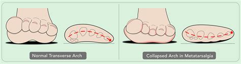 Foot Talk Fridays Metatarsalgia Dubai Podiatry Centre