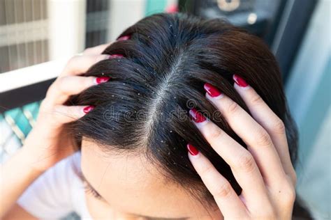 Woman With Dandruff In Her Dark Hair Itchy Head Scalp And Dandruff