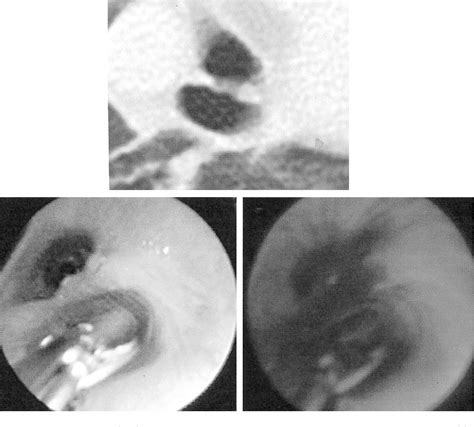 [pdf] Autofluorescence Bronchoscopy Improves Staging Of Radiographically Occult Lung Cancer And