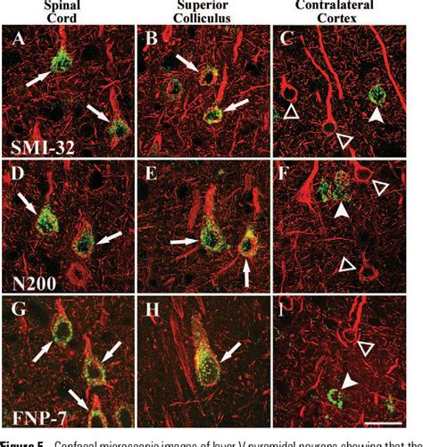 Figure 5 From Selective Neurofilament SMI 32 FNP 7 And N200