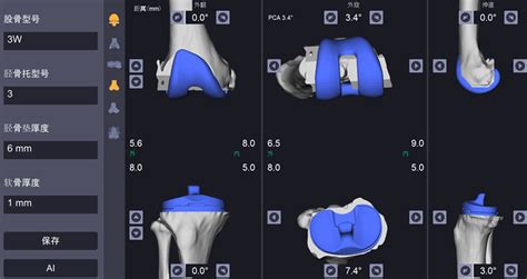 Computer Images Of Planning For Robot Assisted Total Knee Arthroplasty