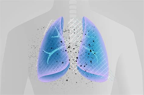 Clinical trial: Dornase alfa for severe COVID pneumonia - Boston ...