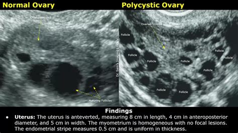 Polycystic Ovarian Syndrome Pcos Ultrasound Report Example How To