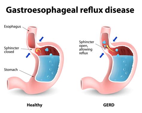 REFLUX(GERD), HIATAL HERNIA, DIAPHRAGMATIC HERNIA - Dr. Mike Liang