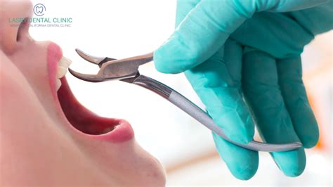 Tooth Extraction Cost Procedure And Everything You Need To Know