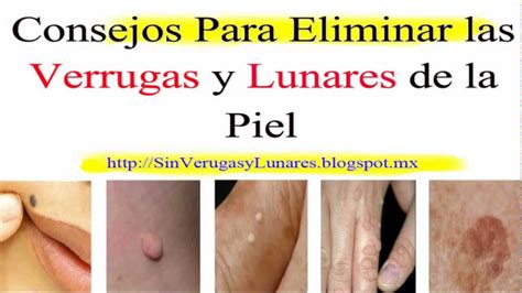 Como Eliminar Las Verrugas Y Lunares De Manera Natural Y Definitiva