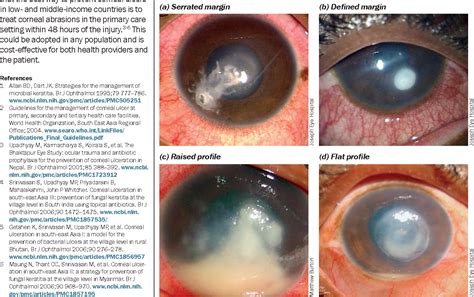 Figure 1 From Distinguishing Fungal And Bacterial Keratitis On Clinical Signs Semantic Scholar