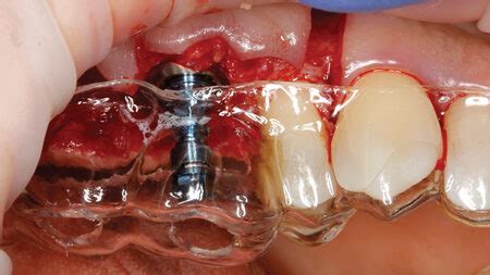 Osseodensification Archives Oral Health Group