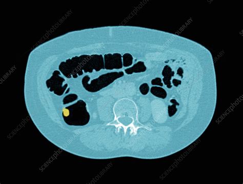 Colon Polyp CT Scan Stock Image C026 9031 Science Photo Library