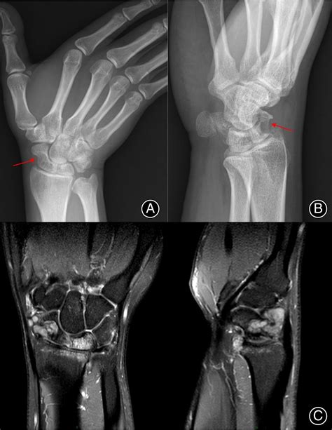 Locally Invasive Pigmented Villonodular Synovitis Of The Wrist Treated