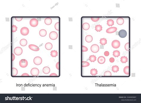 3,463 Thalassemia Blood Images, Stock Photos, 3D objects, & Vectors ...