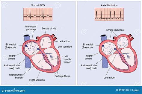 Conducción Eléctrica Del Corazón Normal Y Fibrilación Atrial