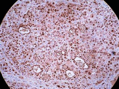 Anaplastic Carcinoma Thyroid Gland Bosnianpathology