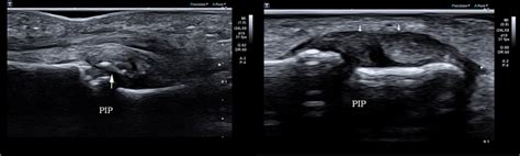 Volar plate injury accompanied by lateral collateral ligament... | Download Scientific Diagram