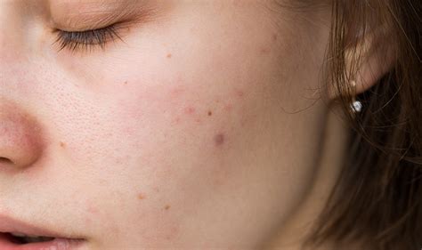 Hormonal Acne What It Is And Why It Happens Columbia Skin Clinic