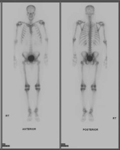 Periostitis On Technetium Bone Scan Following Administration Of 21 9