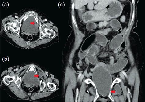 Obturator Hernia A Rare Cause Of Acute Small Bowel Obstruction