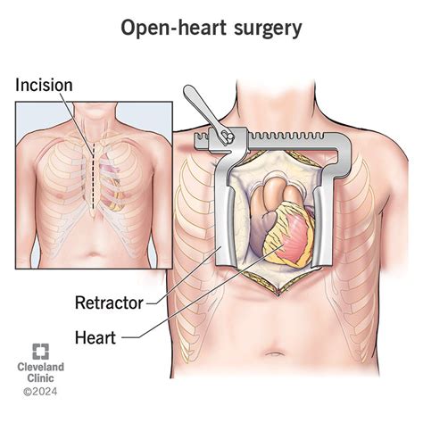 Open Heart Surgery Procedure Details And Recovery