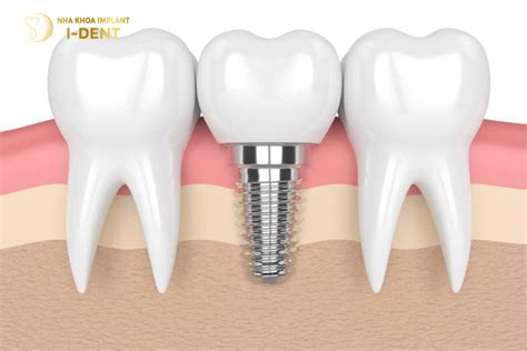 Phục hình trên implant là gì Quy trình diễn ra như thế nào