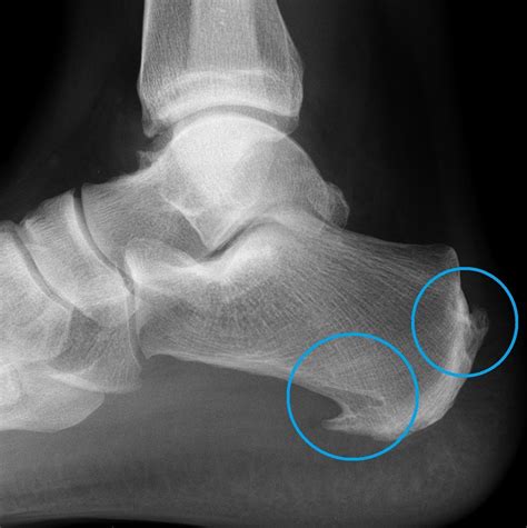 Heel Spurs Dr Ben Beamond Adelaide