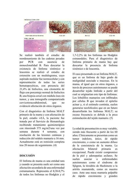 Liinfoma De Tejido Linfoide Asociado A Mucosa Pdf