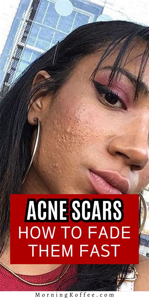 How To Get Rid Of Acne Scars Fast Artofit